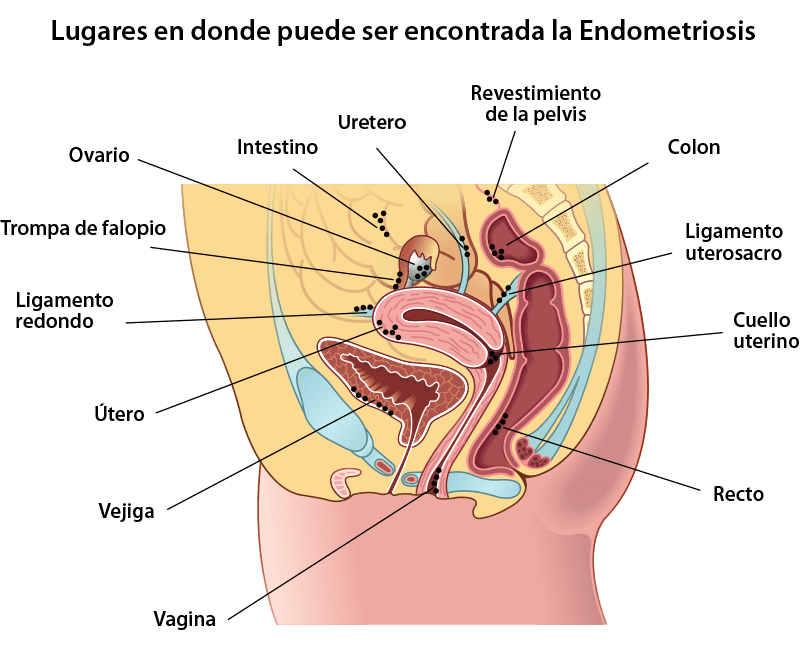 places with endometriosis