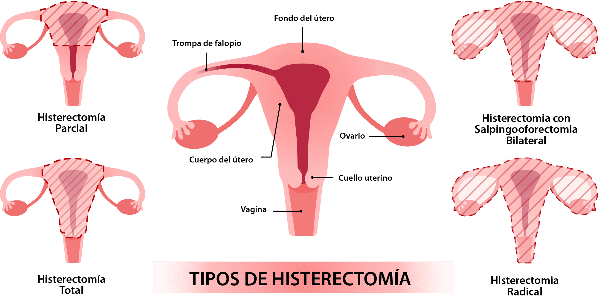 hysterectomy