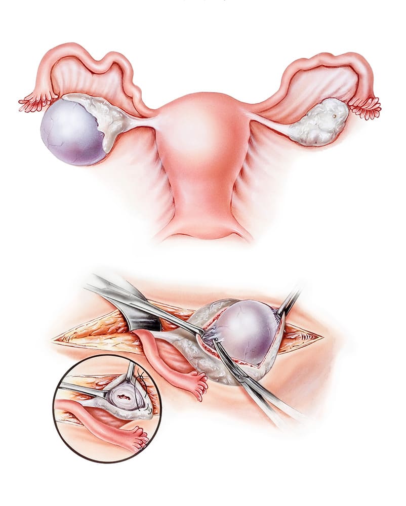 cystectomy